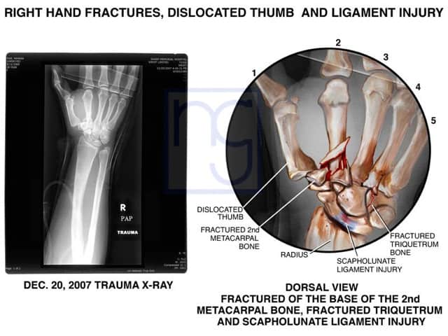 San Diego Right Hand Trauma and Fractures Injury Lawyer